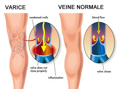 varice schema