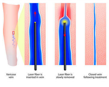 ablation thermique des varices schéma